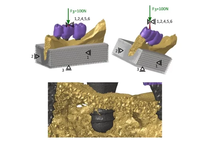 Experimental validation of a micro-CT finite element model of a human cadaveric mandible rehabilitated with short-implant-supported partial dentures – Lana Zupančić Čepić